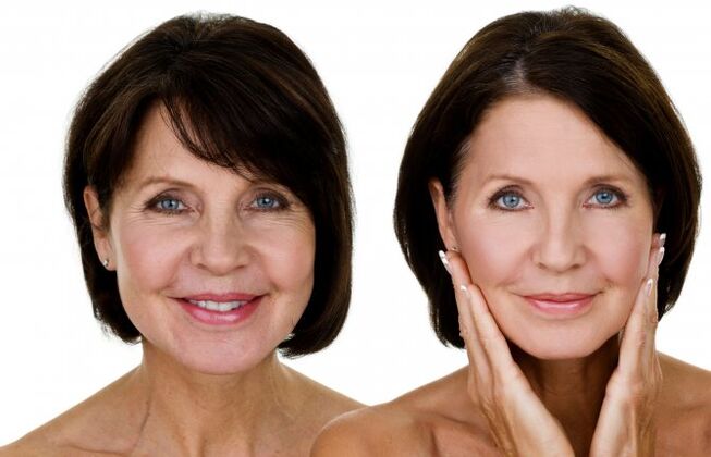 Before and after RF lifts