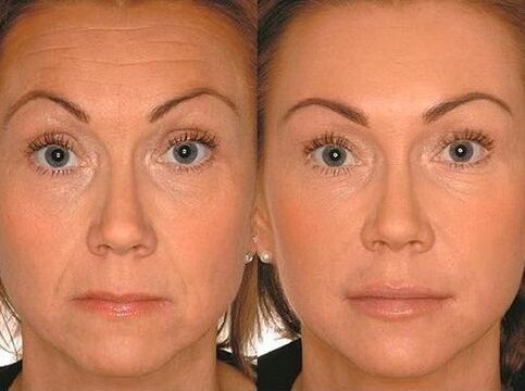 Before and after micro therapy