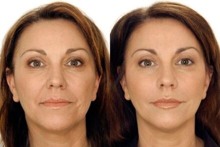 LPG sequence of face before and after