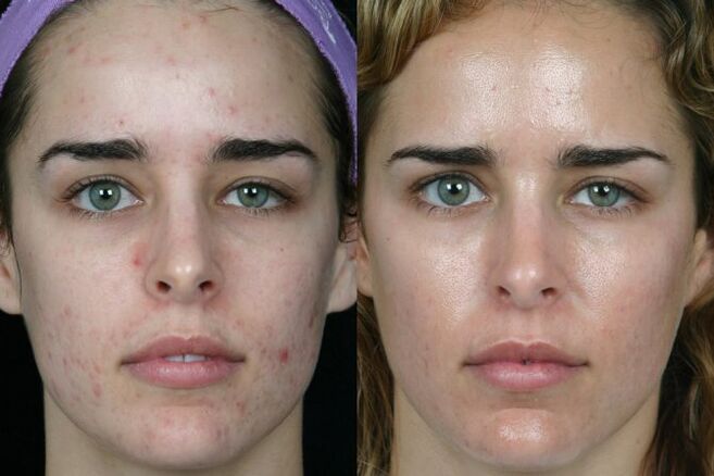 Laser grinds the skin before and after